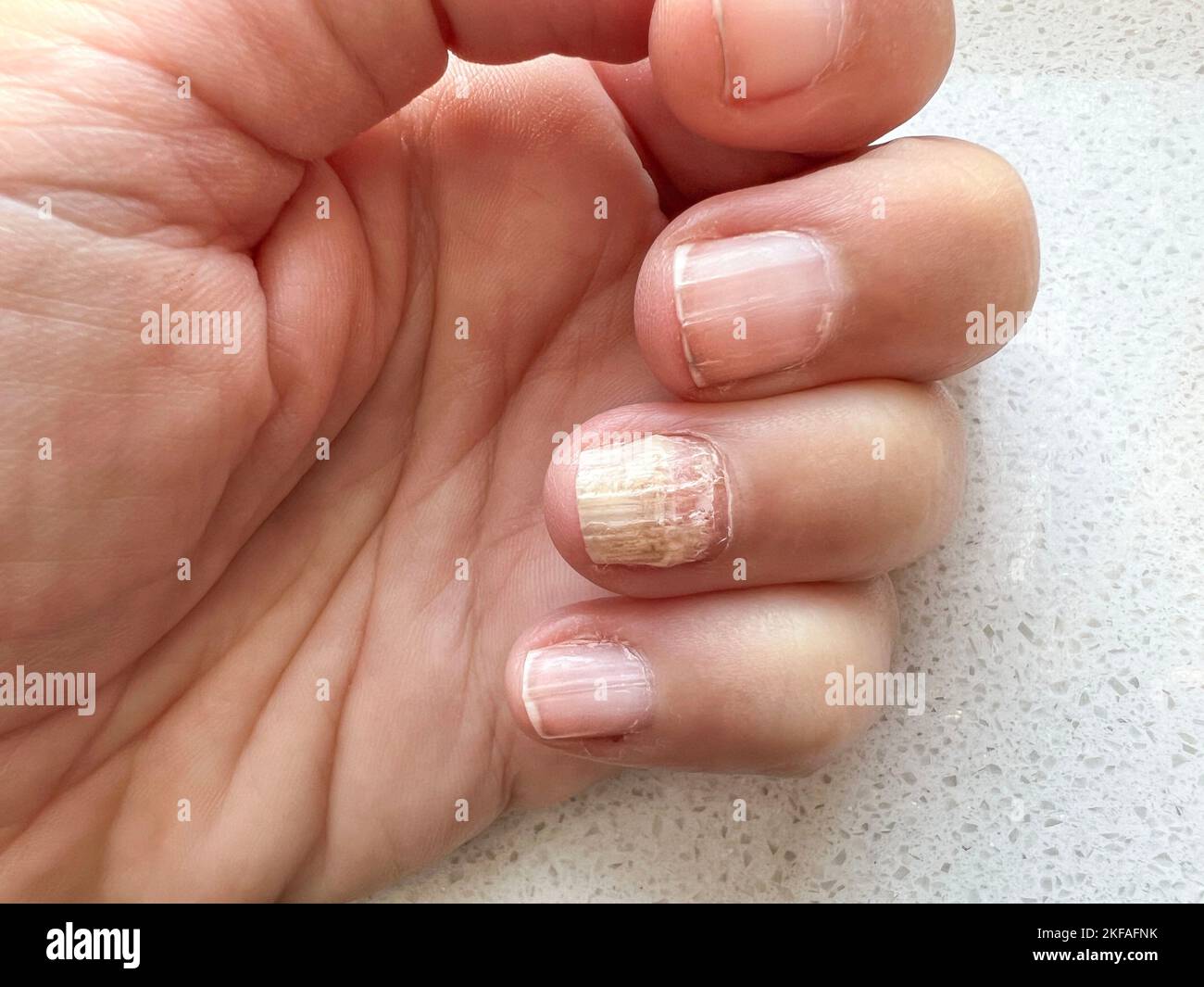 Fungus, Closeup nail fungus infection on hand finger of caucasian woman. Fungal infection on