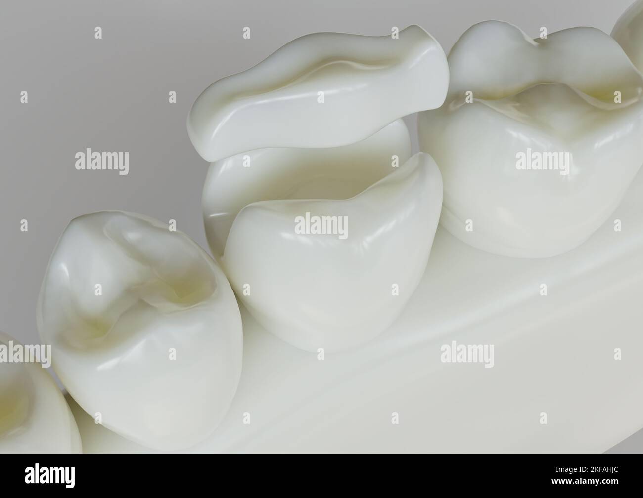 Ceramic Inlay crown over a tooth- 3D Rendering Stock Photo - Alamy