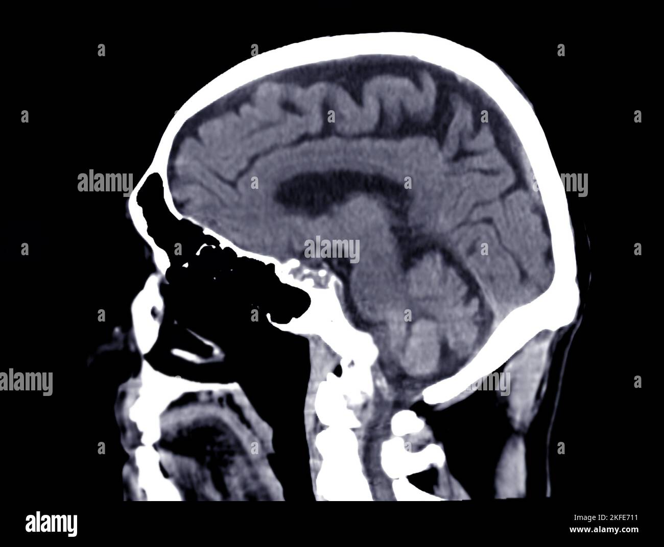 CT scan of the brain sagittal view for diagnosis brain tumor,stroke ...