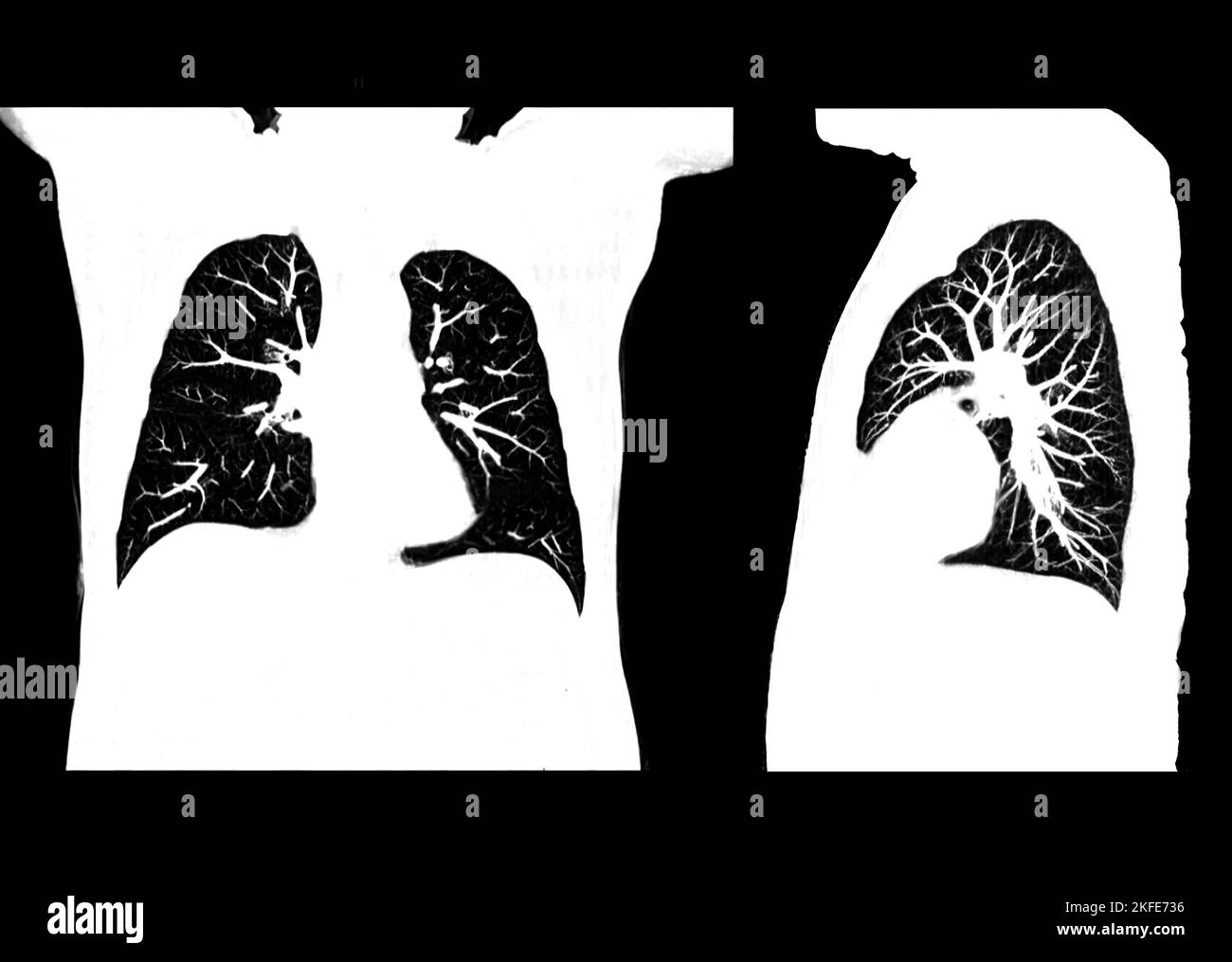CT scan of Chest or lung  at radiology department in hospital. Covid-19 scan body xray test detection for covid virus epidemic spread concept Stock Photo