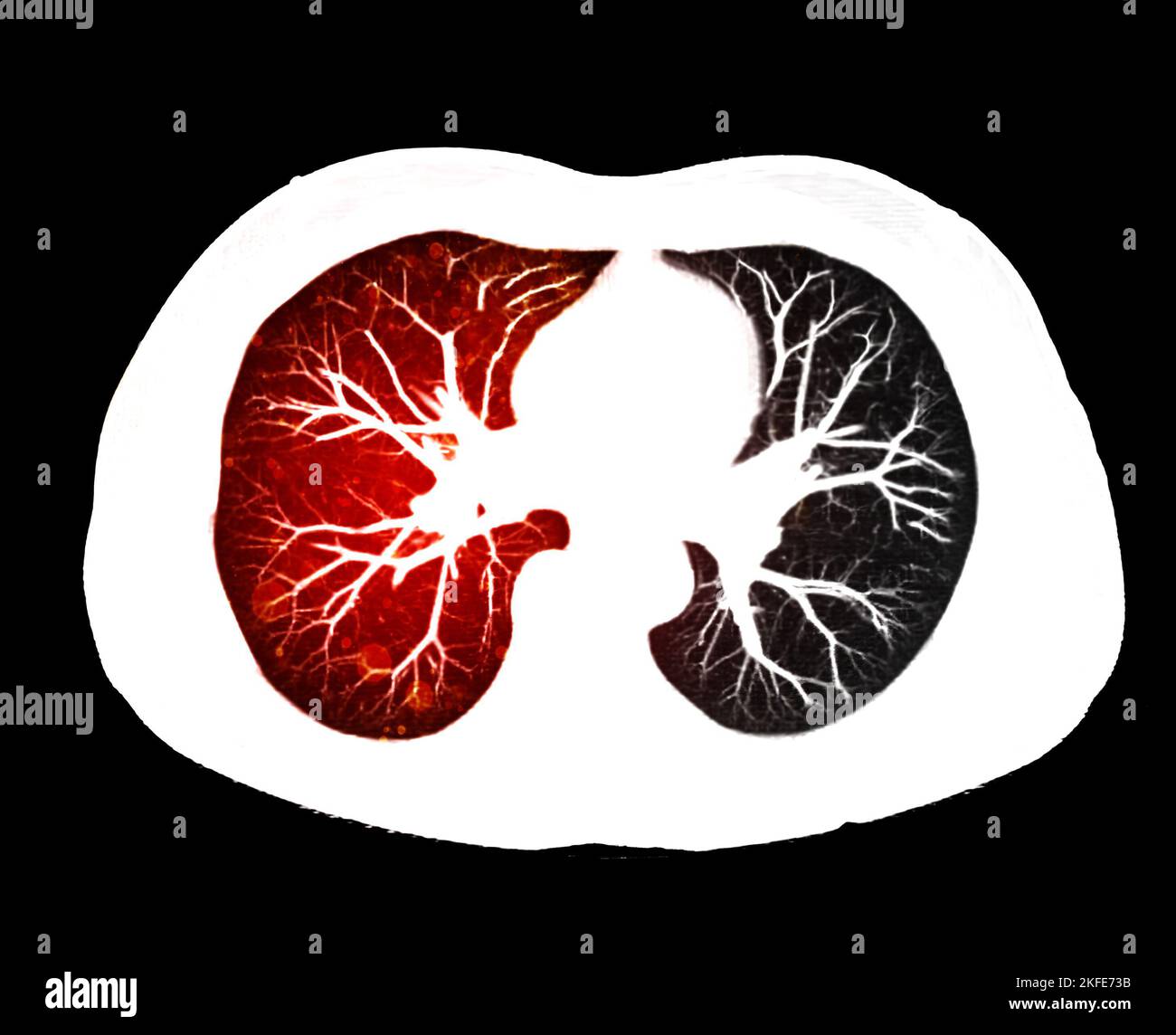 CT scan of Chest or lung axial view at radiology department in hospital