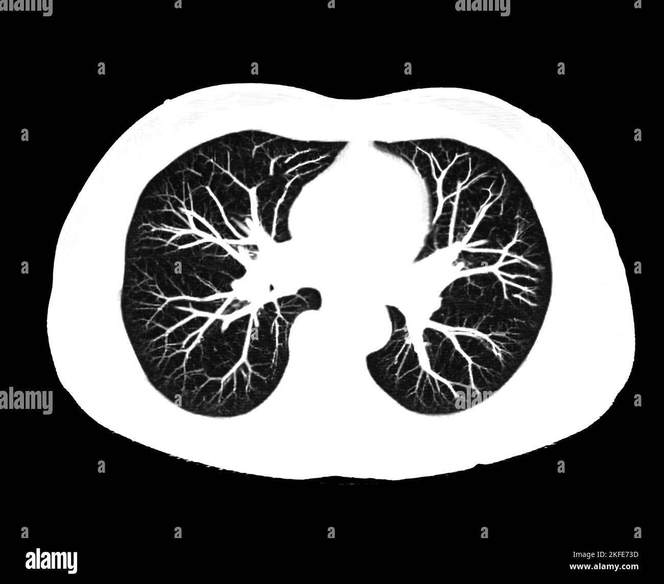 CT scan of Chest or lung axial view at radiology department in hospital