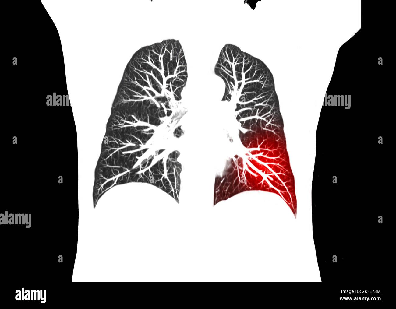 CT scan of Chest or lung  coronal view at radiology department in hospital. Covid-19 scan body xray test detection for covid virus epidemic spread con Stock Photo