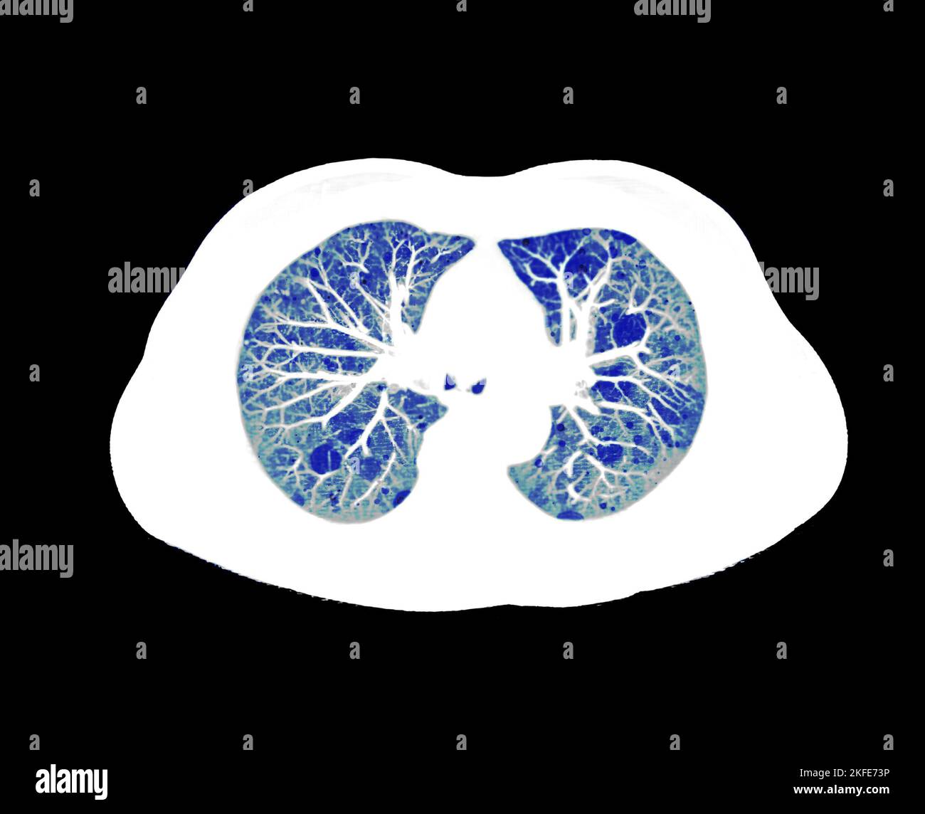 CT scan of Chest or lung axial view at radiology department in hospital