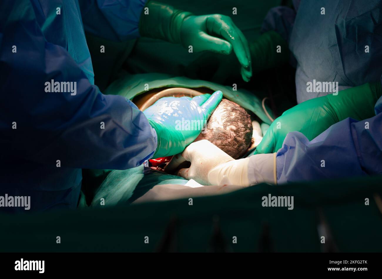 Cesarean Section, close up of the baby being removed from mothers womb during surgery Stock Photo