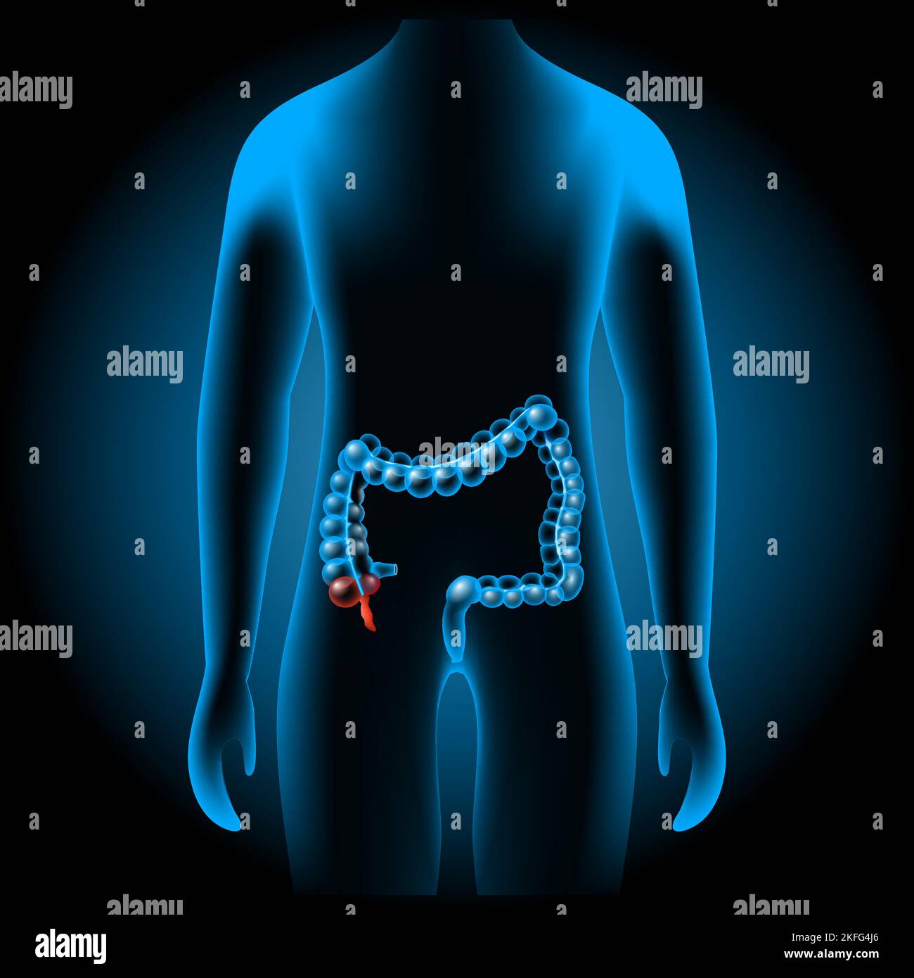 Appendicitis. inflammation of the appendix. Red vermix, or part of cecum into x-ray blue realistic torso. large intestine. Gastrointestinal tract. Stock Vector