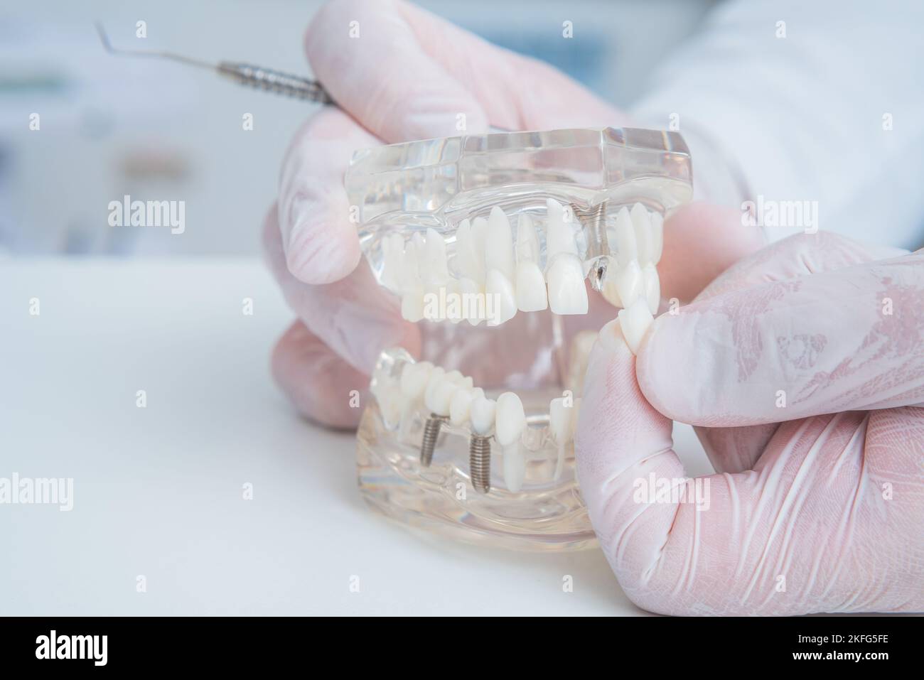 the orthodontist holds a model of teeth with implants in his hand and shows how to insert the