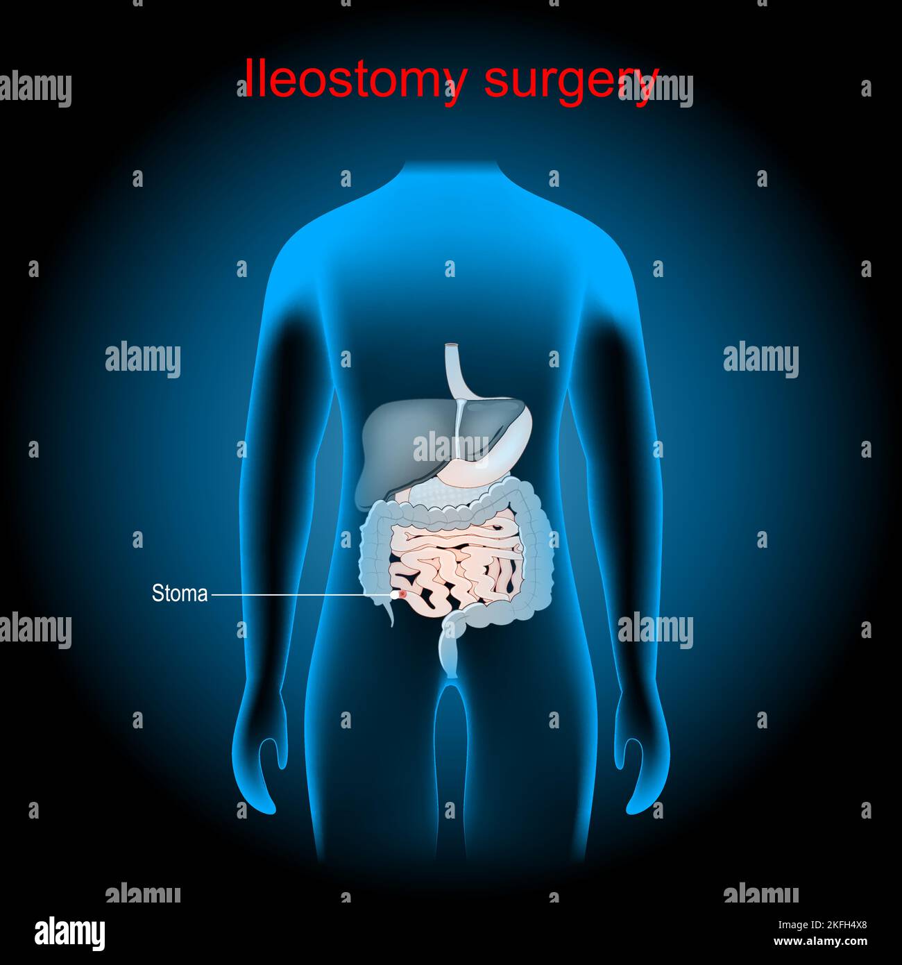 Ileostomy. stoma. surgical opening of small intestine, the ileum out the surface of the skin. surgical procedure. x-ray blue realistic torso Stock Vector
