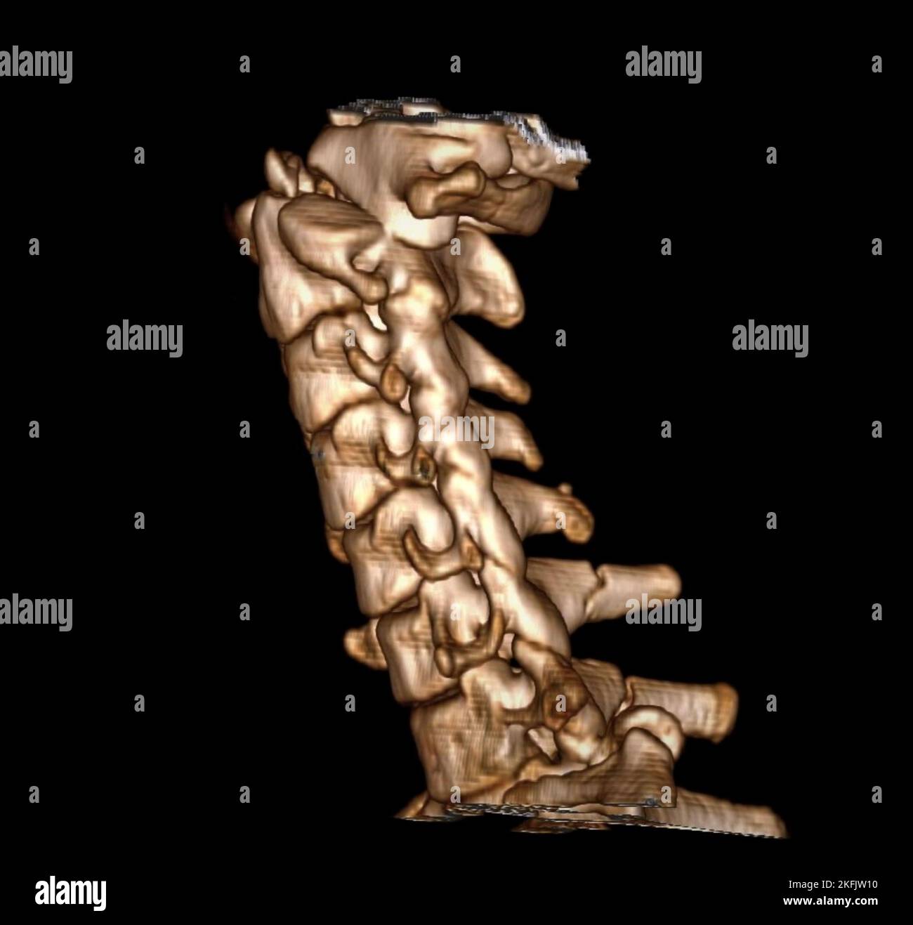 Dislocated neck bones, 3D CT scan Stock Photo
