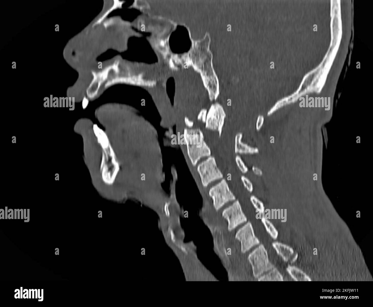 Dislocated neck bones, CT scan Stock Photo