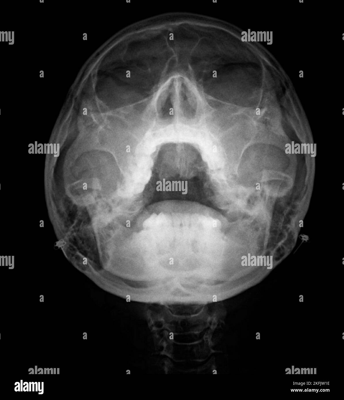 Sinusitis, X-ray Stock Photo