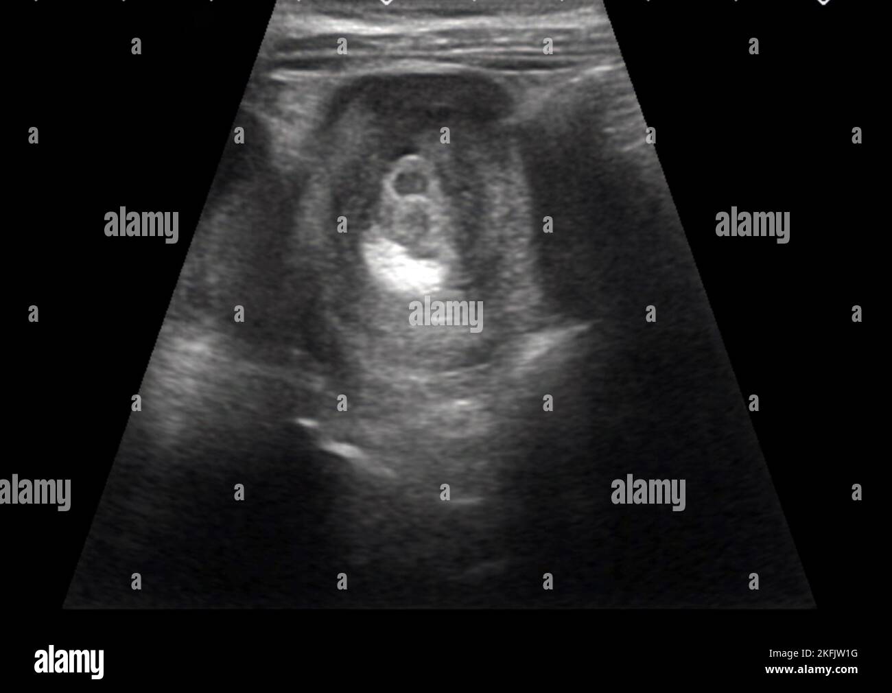 Intussusception of the intestines, ultrasound scan Stock Photo