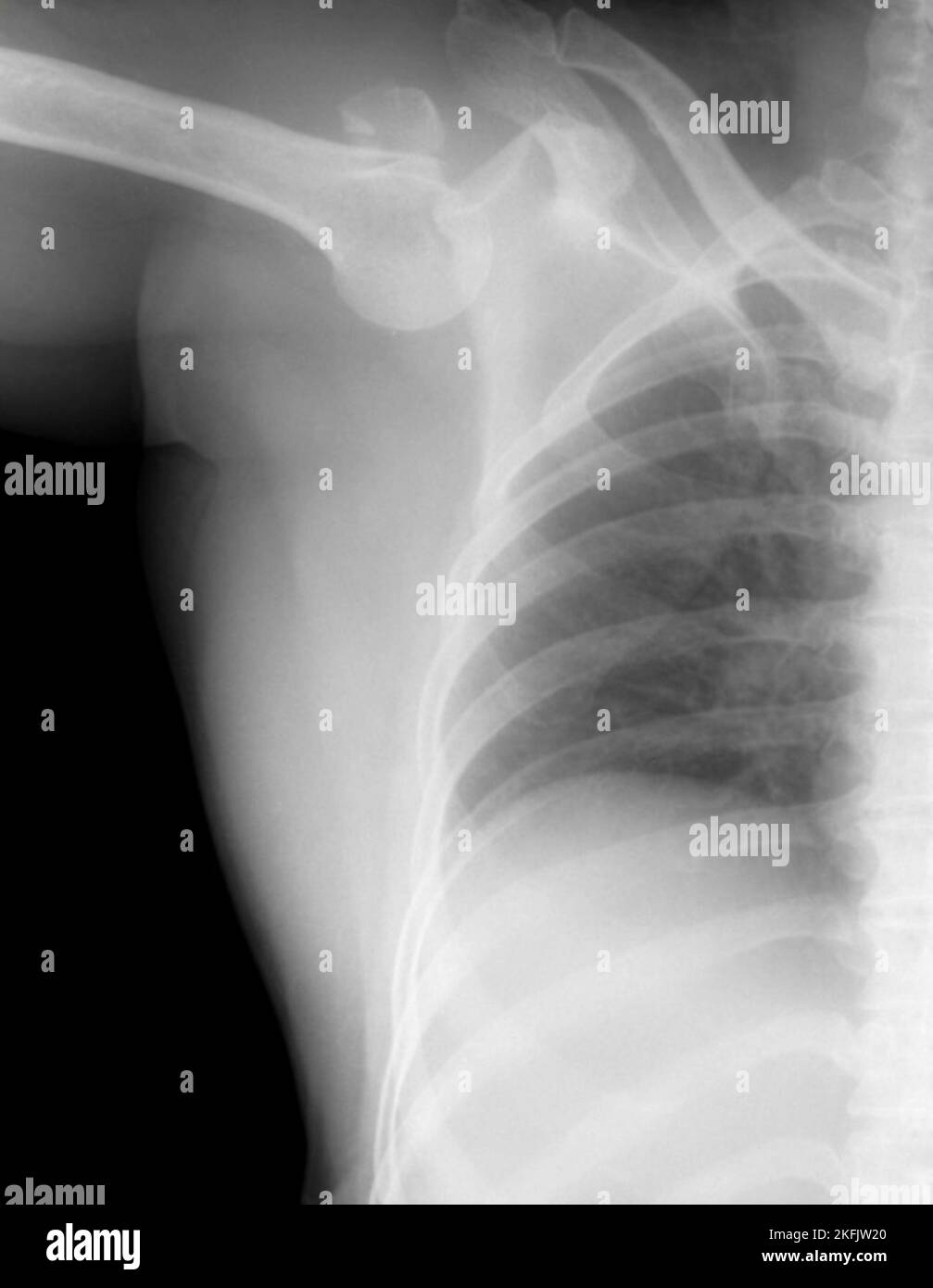 Xray of a dislocated shoulder. This is an inferior dislocation with a