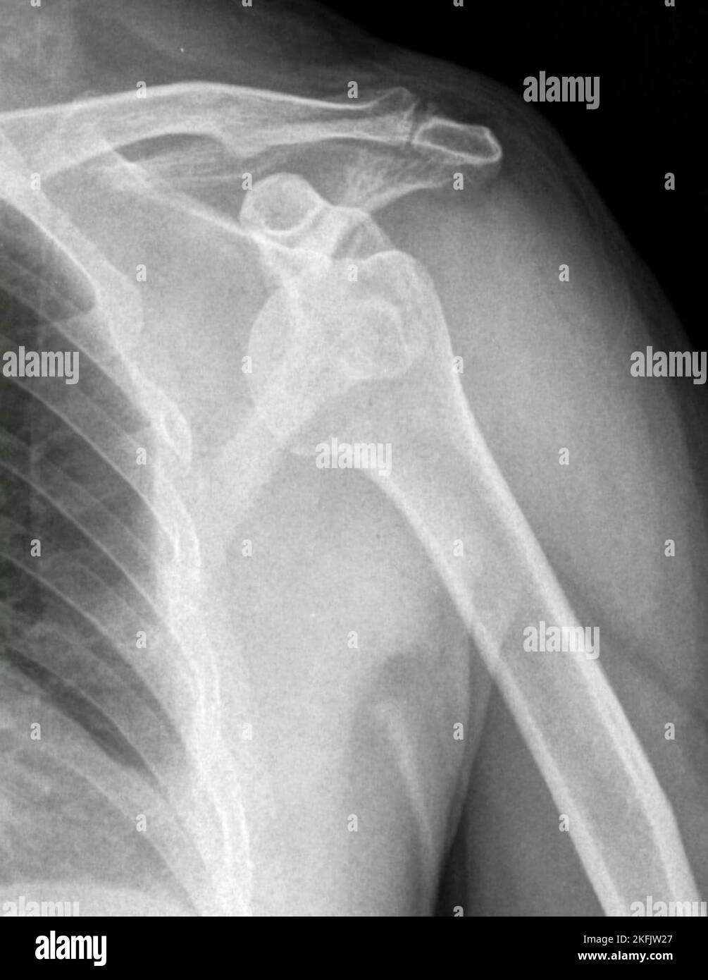 X ray left shoulder cpt code