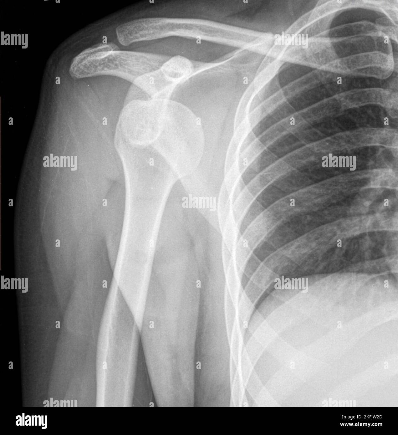Dislocated shoulder, X-ray Stock Photo