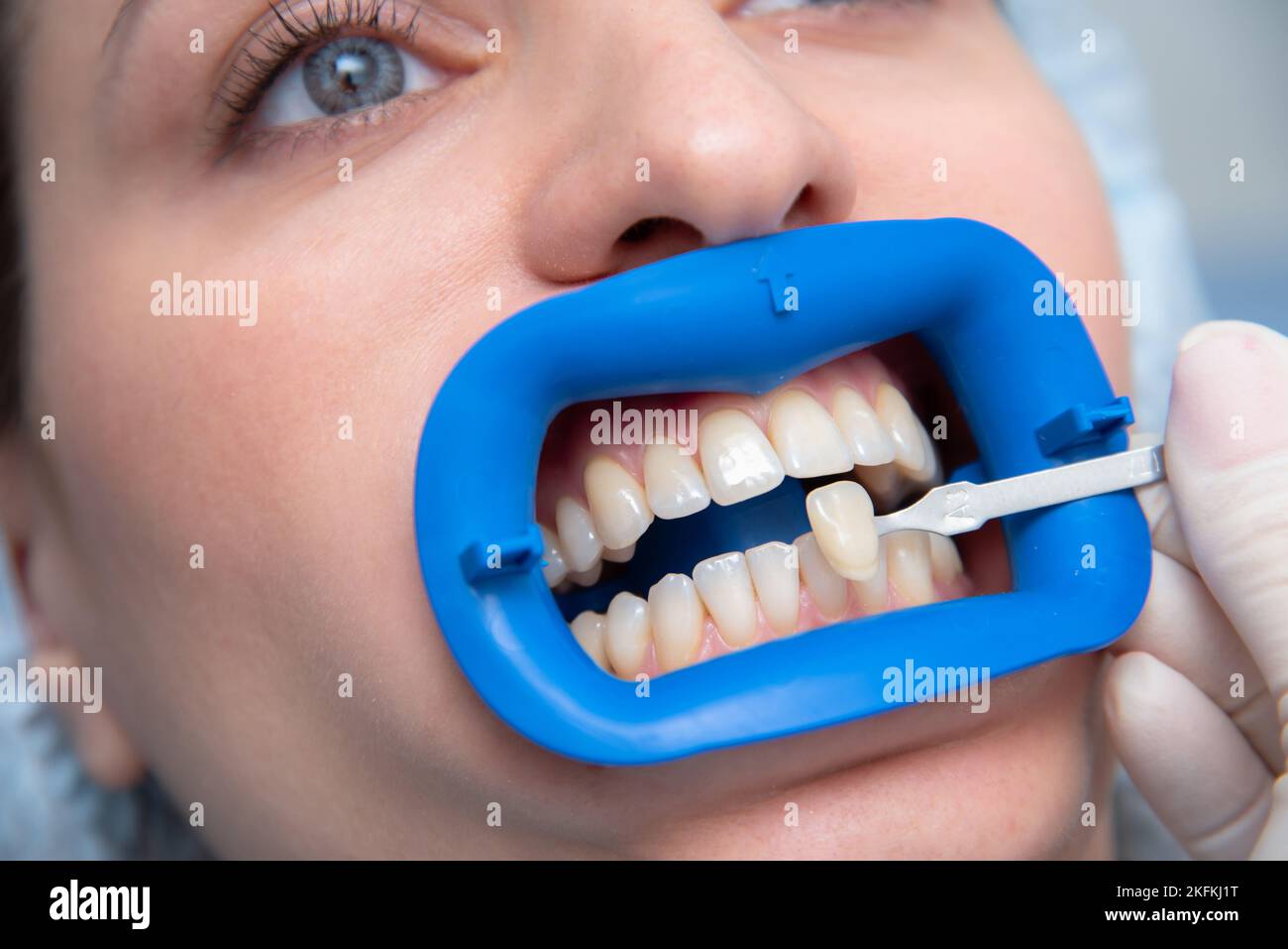 procedure for comparing the color shades of teeth before bleaching