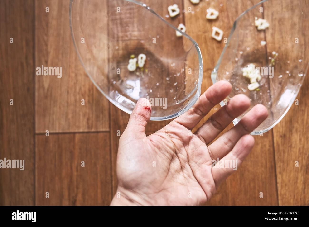 Fractured hand hires stock photography and images Alamy