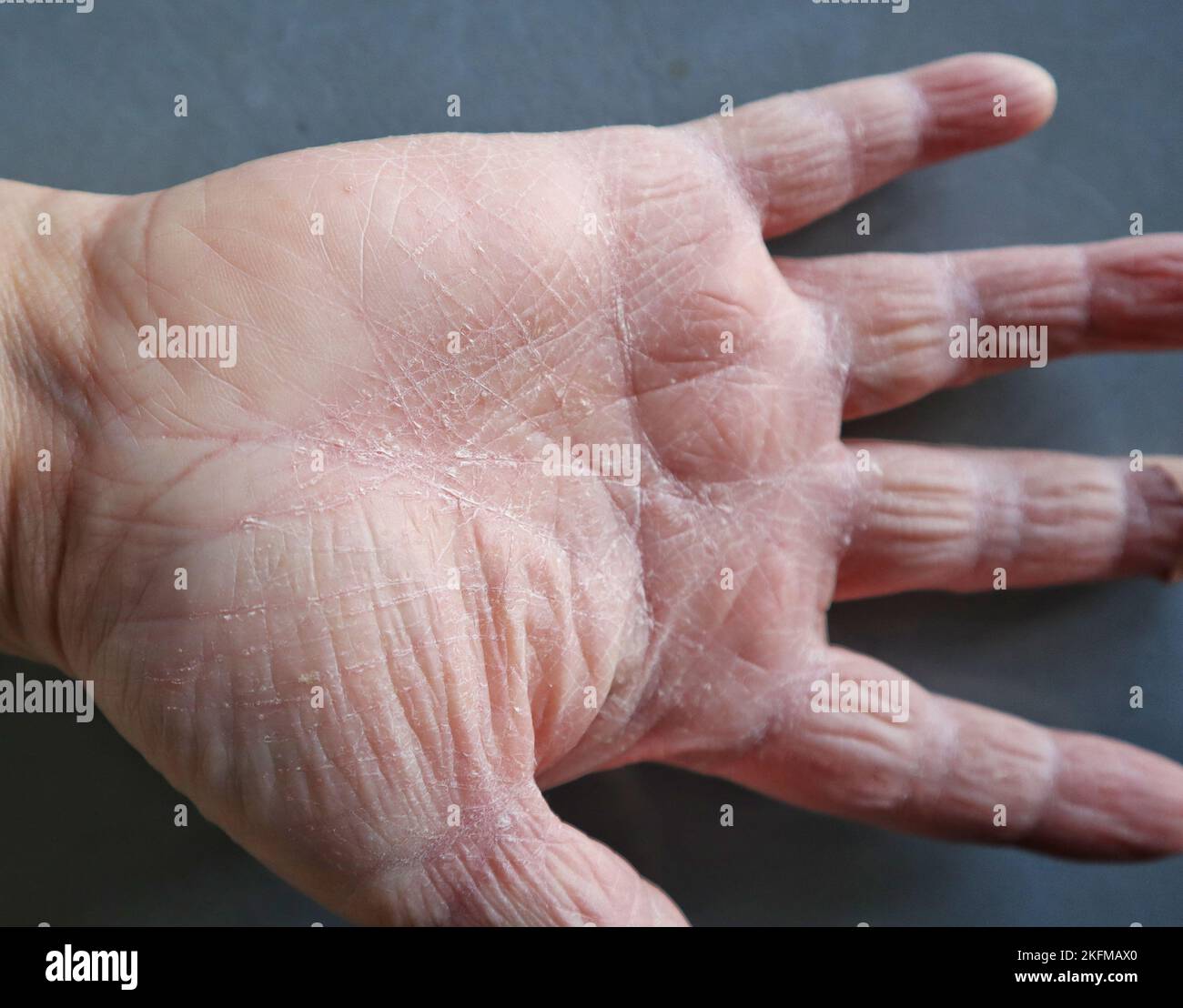 dry skin on hands Stock Photo