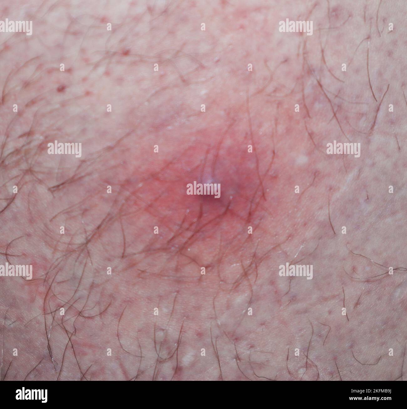 Dermatology macro abscess skin hi-res stock photography and images - Alamy