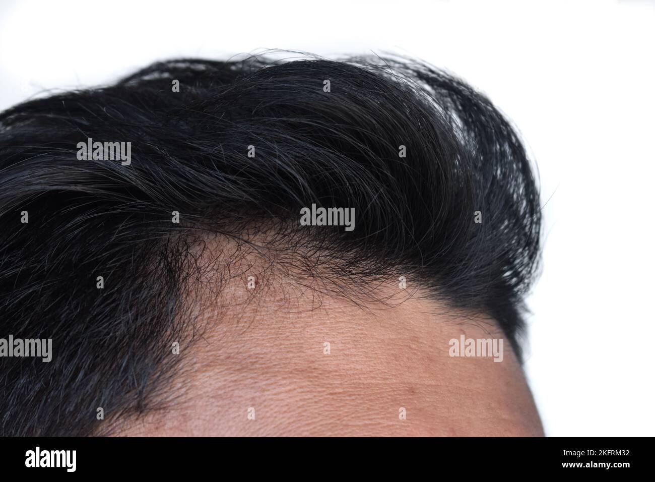 Thinning or sparse hair, male pattern hair loss in Southeast Asian, Chinese young man. Stock Photo