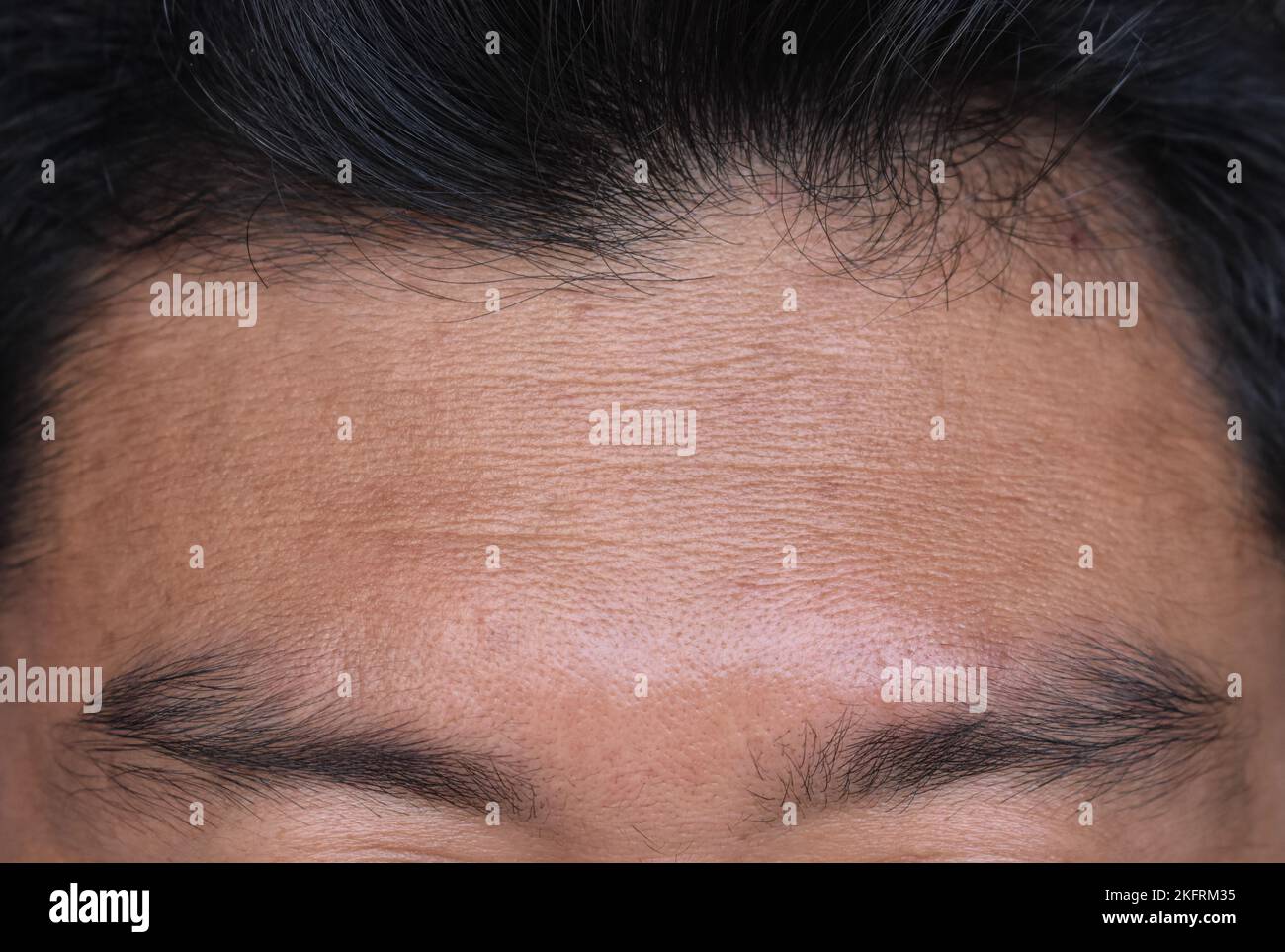 Skin creases or wrinkles at the forehead of Southeast Asian, Myanmar or Burmese man. Symptom of aging. Stock Photo