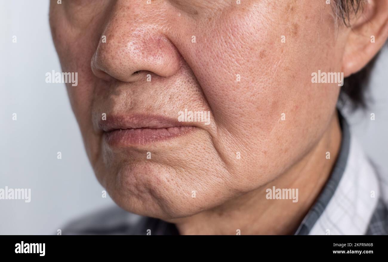 Enlarged pores in face of Southeast Asian, Chinese elder man with skin folds. Stock Photo