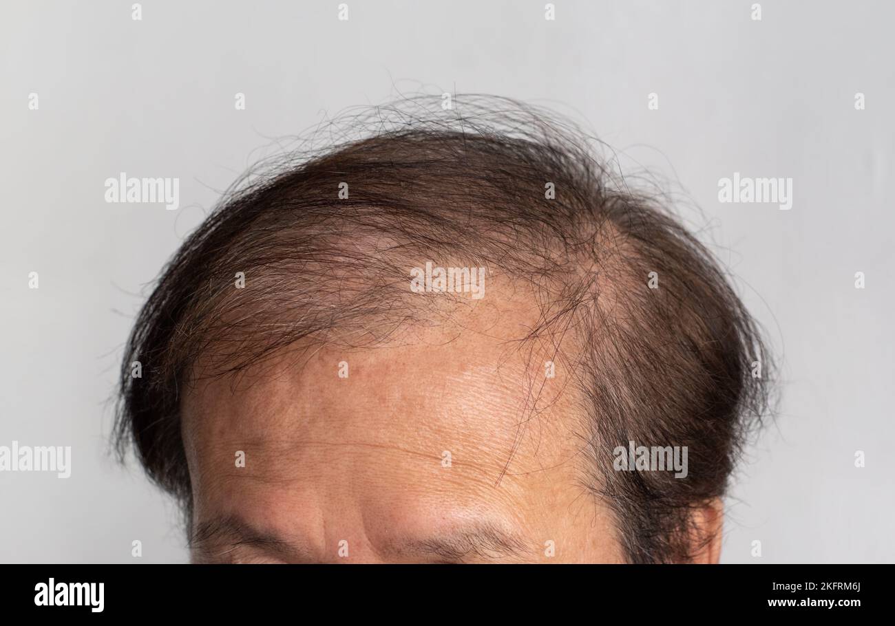 Bald head of Asian elder man. Concept of male pattern hair loss or sparse hair. Stock Photo