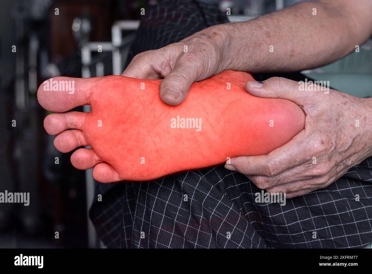 Tingling and burning sensation in foot of Asian elder man with diabetes