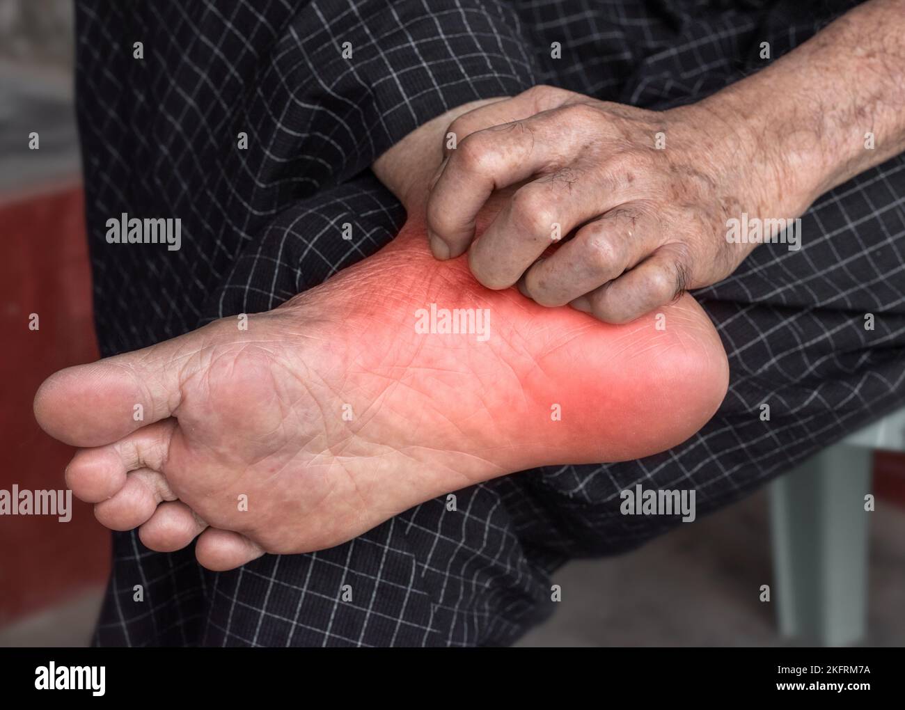 Itchy foot skin of Asian elder man. Concept of skin diseases such as scabies, fungal infection, eczema, psoriasis, rash, allergy, etc. Stock Photo