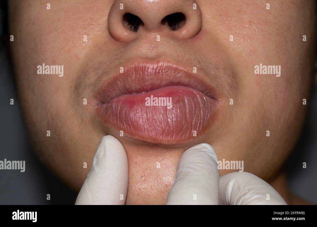 Swollen or thickened lip of Asian young man. Angioedema. Causes may be allergies, infection, injury, etc. Stock Photo