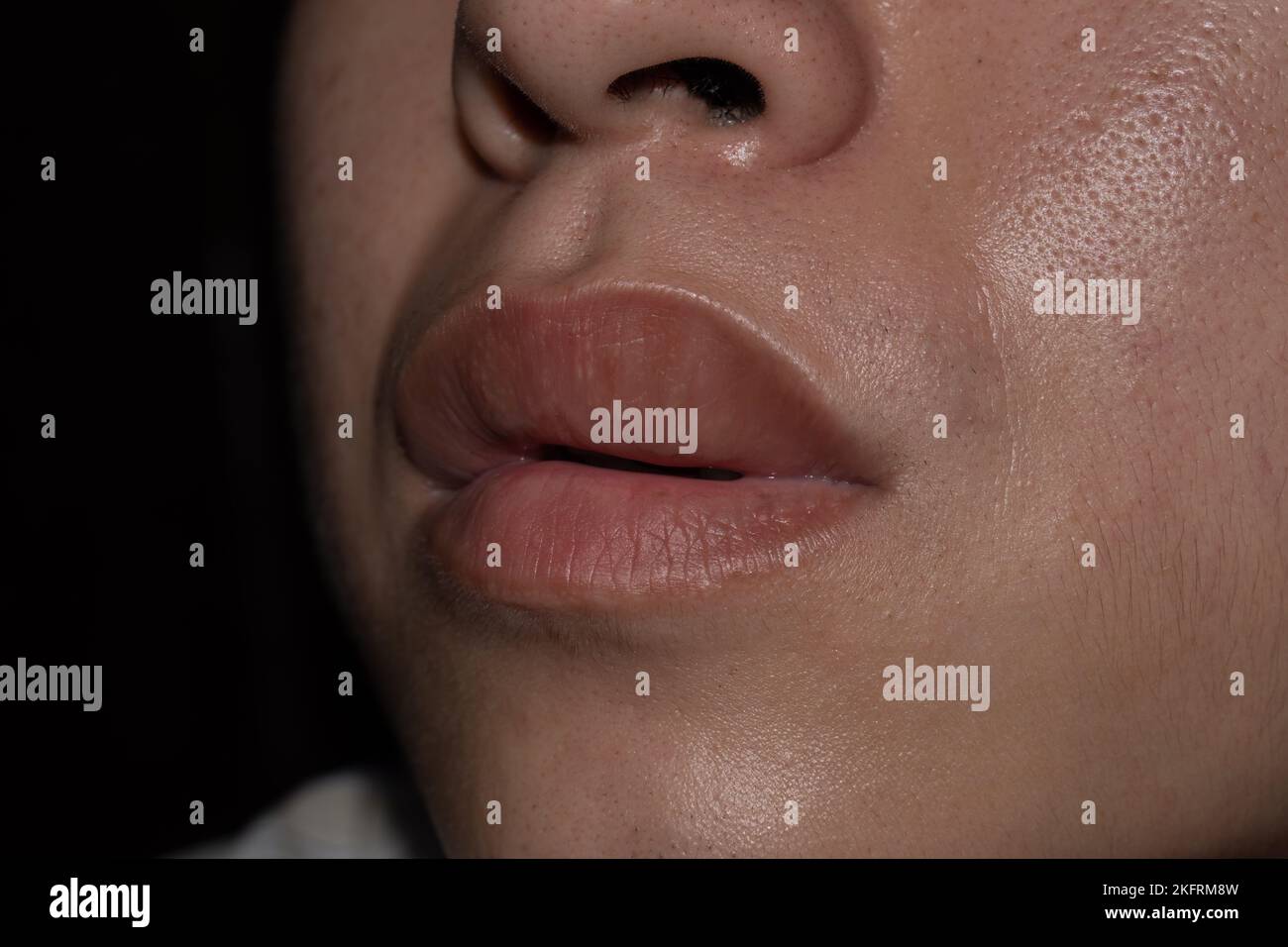 Swollen or thickened upper lip of Asian young man. Angioedema. Causes