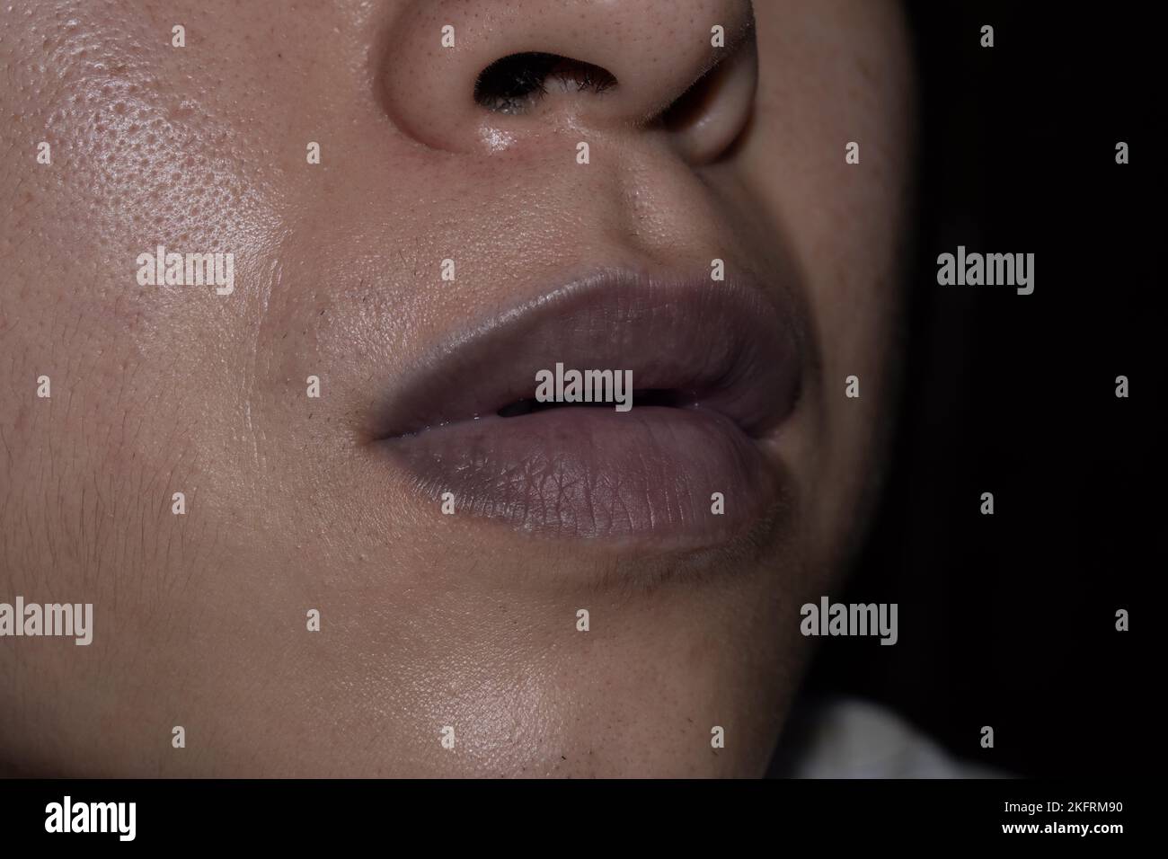 Heart Problem Lips Central cyanosis in the lips of Southeast Asian young man with ...