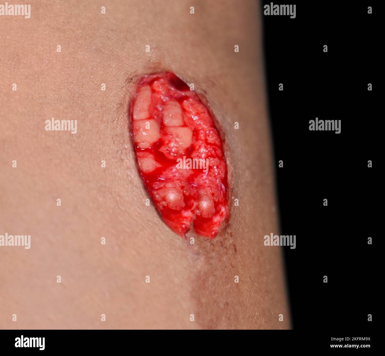 Lacerated wound with slight bleeding. Traumatic injury in thigh of Asian child. Stock Photo