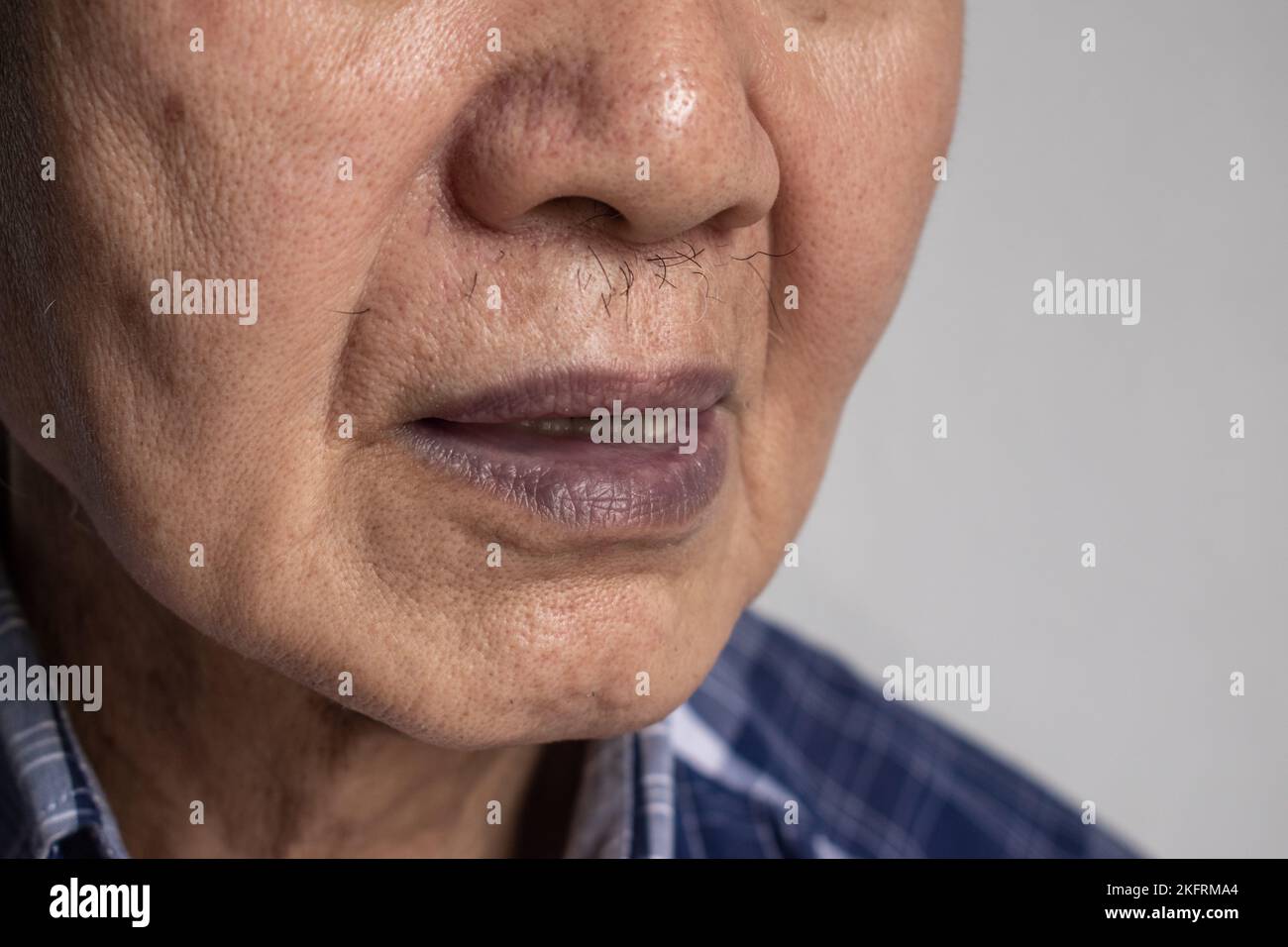 Central cyanosis in Southeast Asian old man with congenital heart disease. Stock Photo