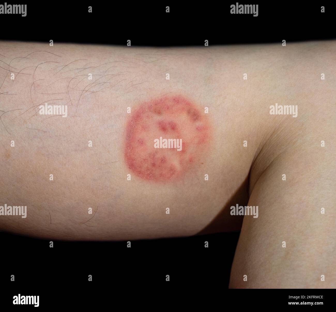 Fungal infection called tinea corporis in Southeast Asian man. Ringworm Stock Photo