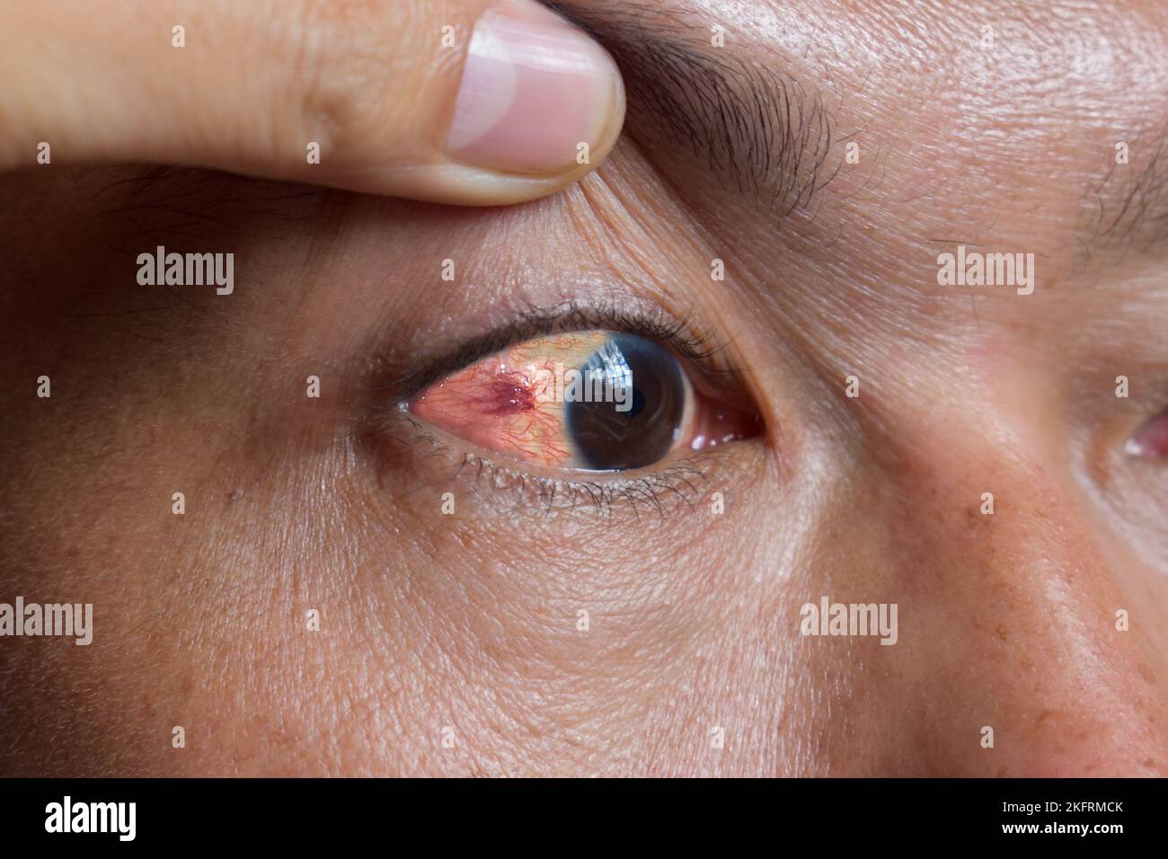 Ocular larva migrans or dilated vessels in the eye of Southeast Asian man. Stock Photo