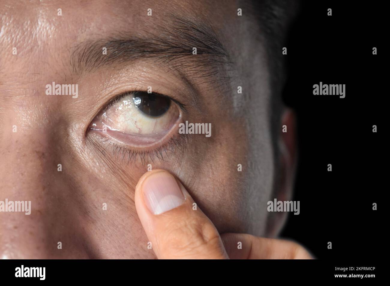 Pallor cyanosis hires stock photography and images Alamy