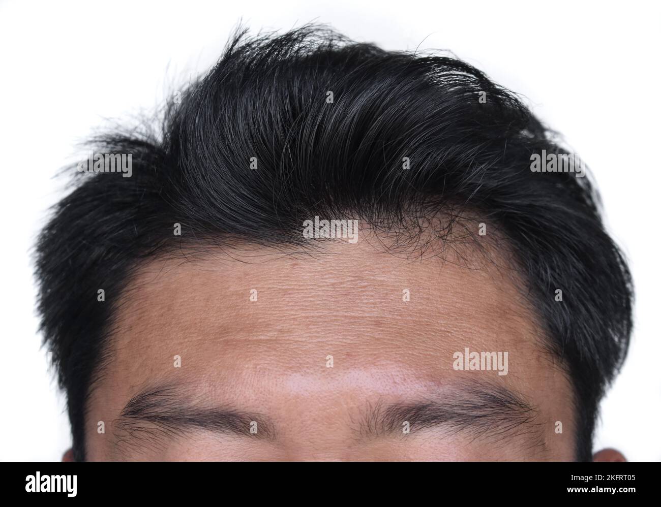 Thinning or sparse hair, male pattern hair loss. Wrinkles or folds in the forehead of Southeast Asian, Chinese man. Stock Photo