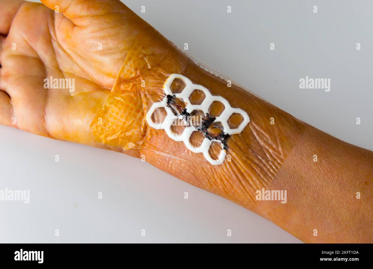 Postoperative wound dressing with wound pad and bacteria