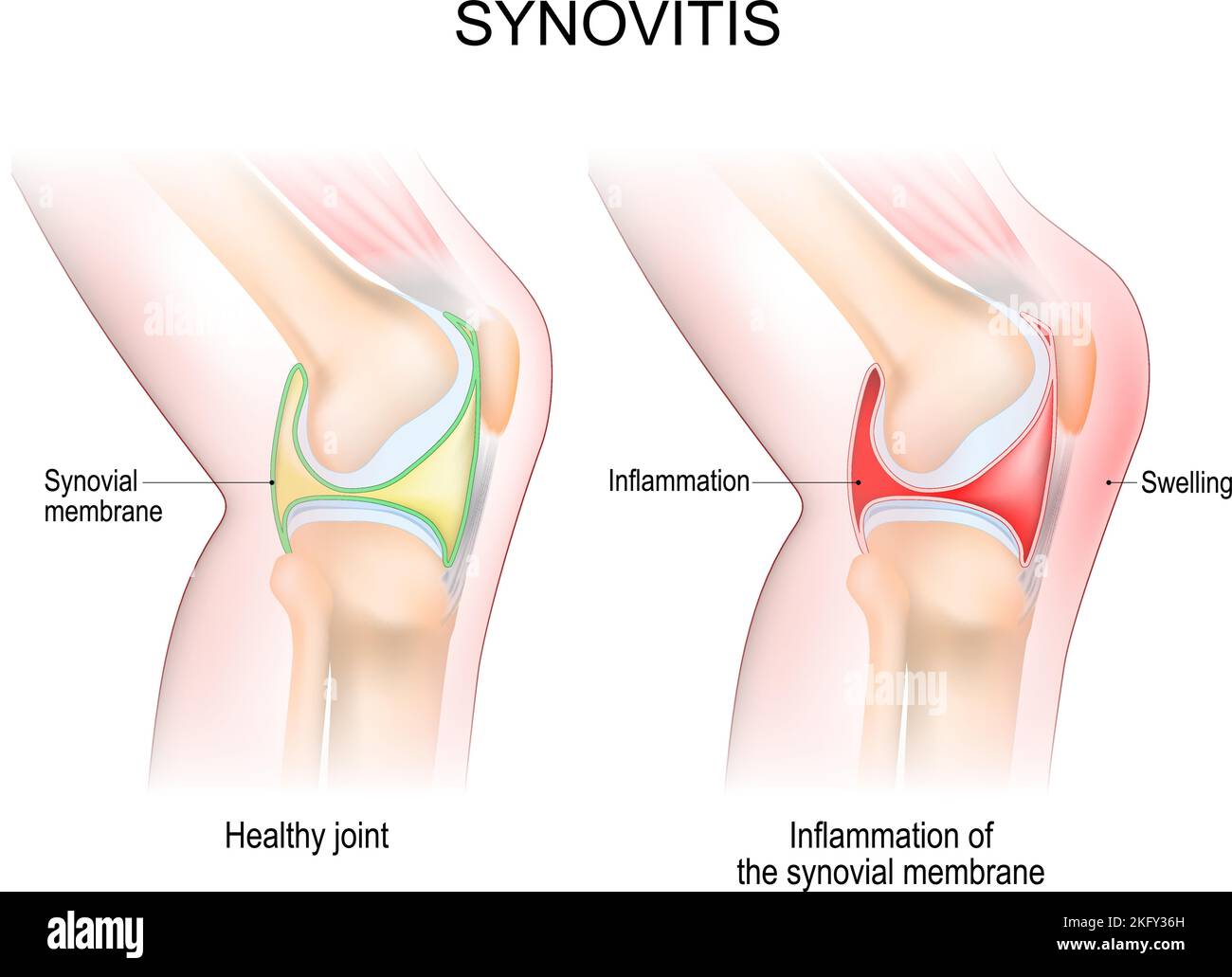 synovitis of a Knee. Close-up of normal joint, and knee with inflammation of the synovial membrane. Signs and symptoms of the disease. side view Stock Vector