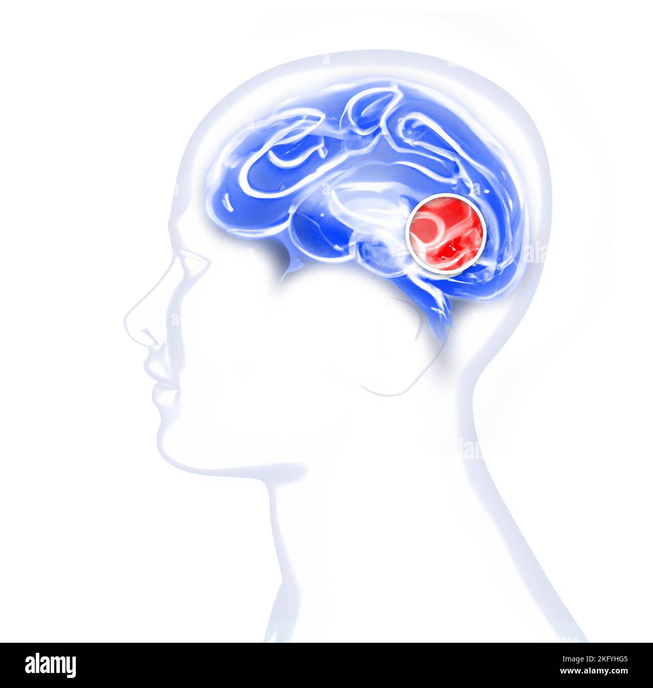 Pain in the head, brain and synapses, cognitive problems, mental deficit. Aneurysm. Degenerative diseases affecting the brain area. Parkinson Stock Photo