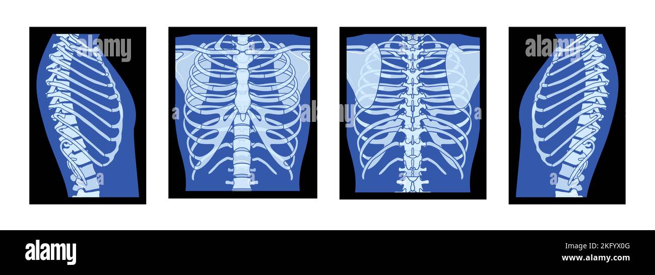 Set of X-Ray Rib cage Skeleton Human body - chest, vertebra, Bones adult people roentgen front back side view. 3D realistic flat blue color concept Vector illustration of medical anatomy isolated Stock Vector