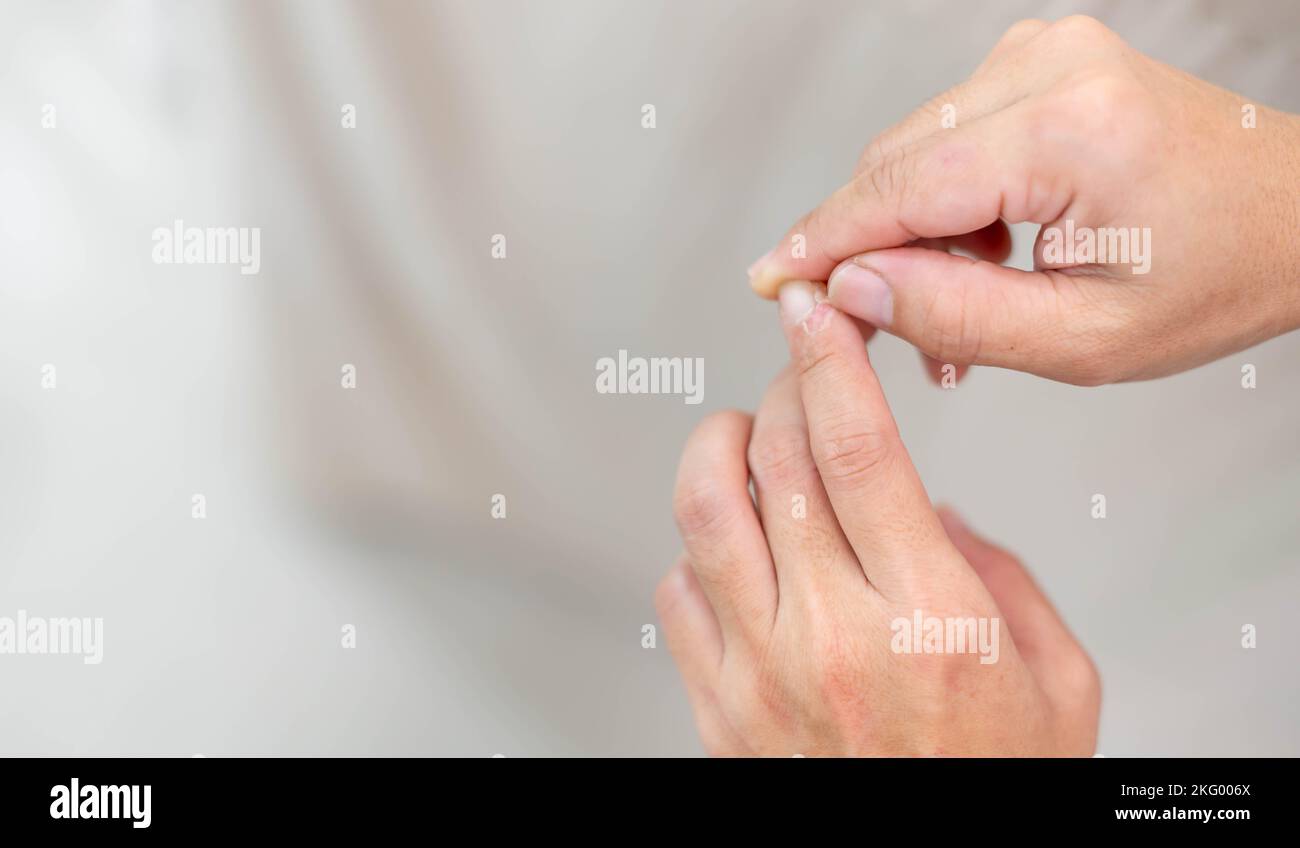 Female hand pointing to dry, cracked skin on cuticles, skin is torn and flaking off should be