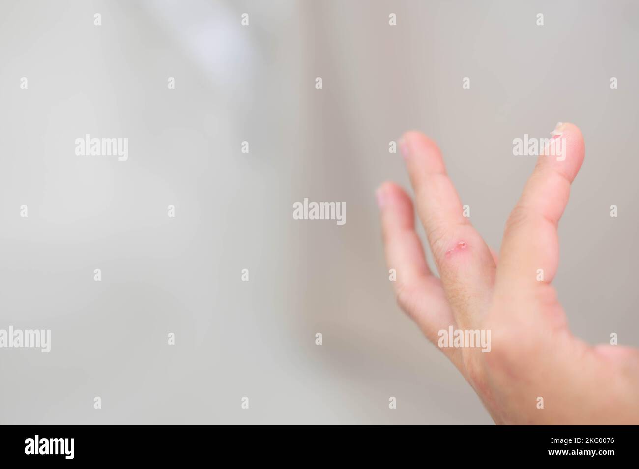 Cuticle wound hires stock photography and images Alamy