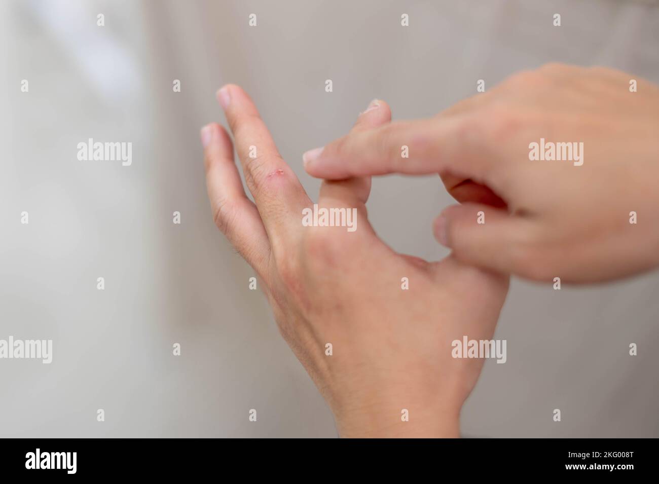 Female hand pointing to dry, cracked skin on cuticles, skin is torn and