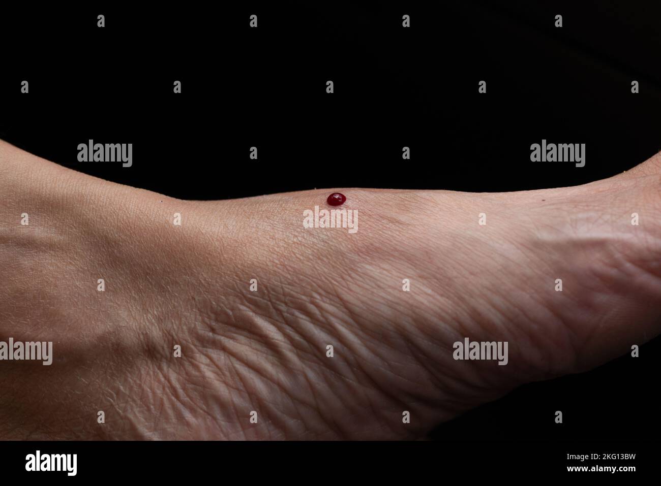 Close-up view of bleeding on the woman foot after removal of leech sucking blood. Stock Photo