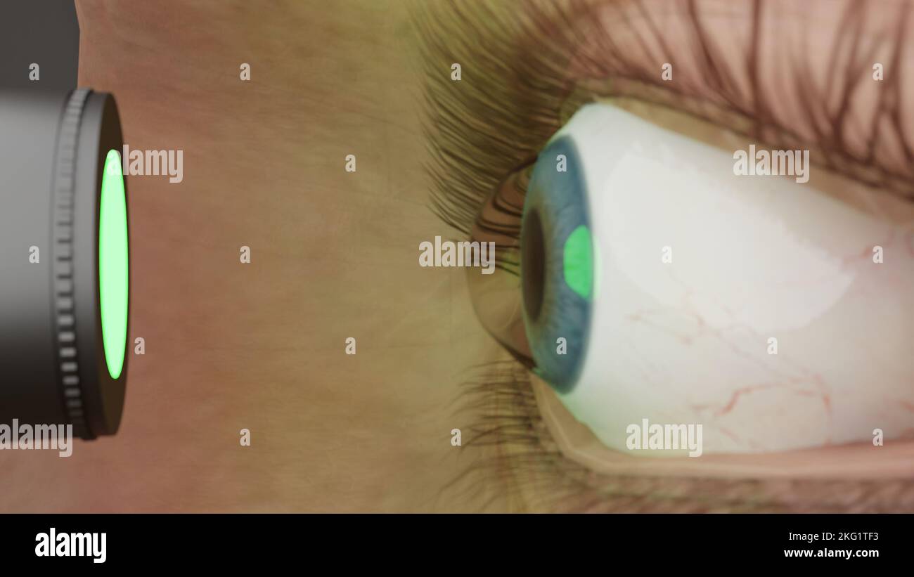 Render of laser treatment for keratoconus of the eye. Curvature of the cornea in the form of a