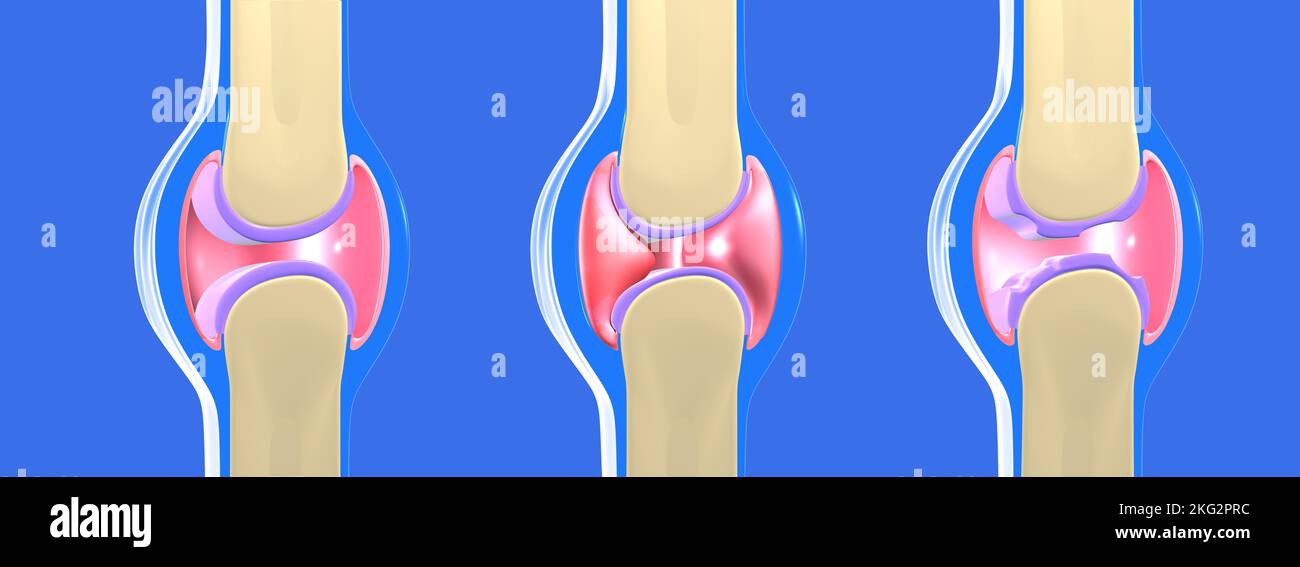 3D illustration of synovial joint and other joints with osteoarthritis