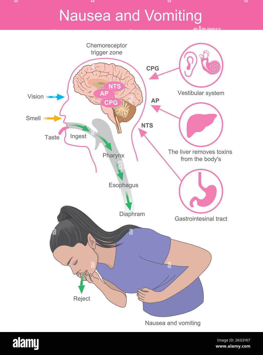 Nausea and Vomiting. A woman with symptoms the nausea and vomiting which is the effect of brain processes. Stock Vector