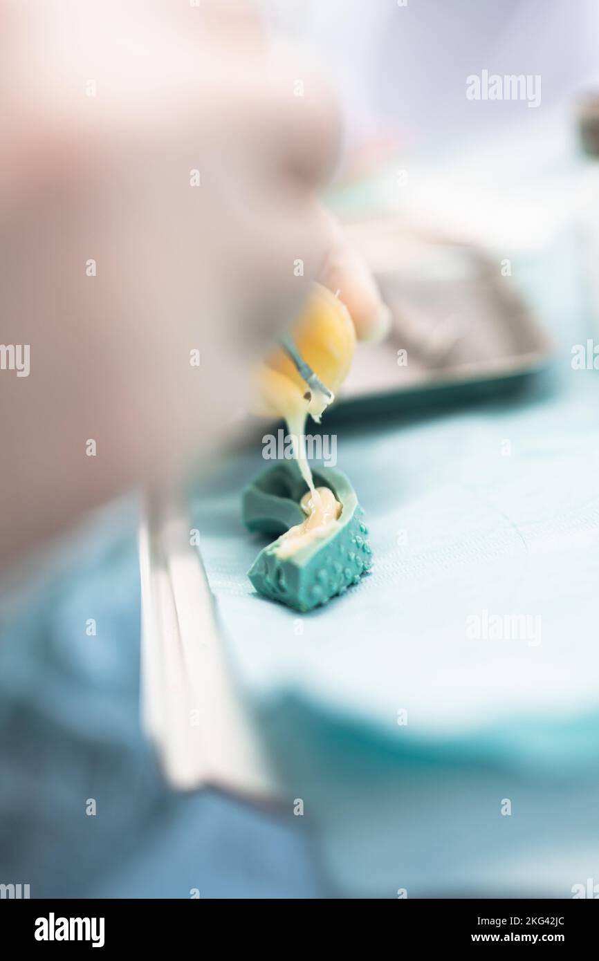 Pouring Acrylate in Dental Impression for Temporary Dental Crowns Stock Photo Alamy